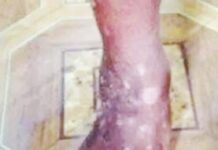 Piden población RD no alarmarse ante infección cutánea en Haití